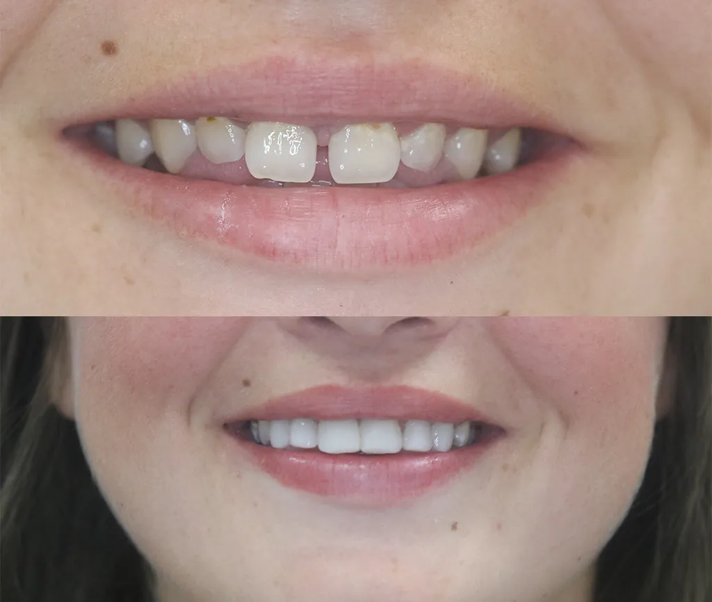 Complete smile makeover result with composite bonding and whitening
