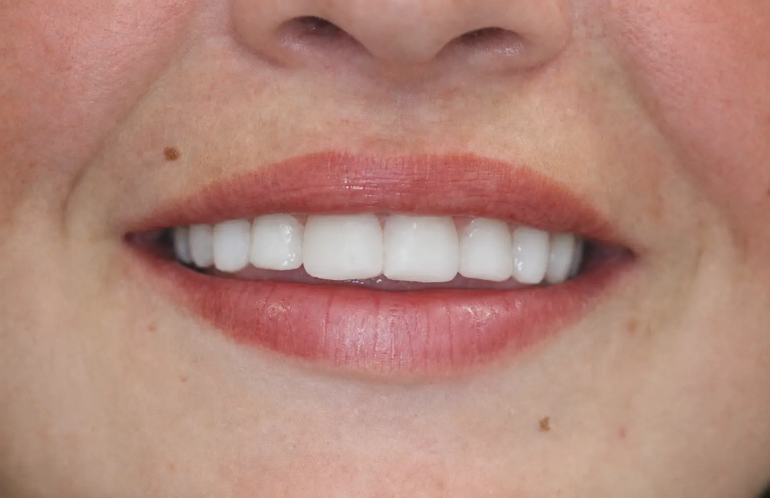 Complete smile makeover result with composite bonding and whitening